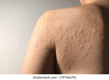 Severe Itching From Urticaria On Shoulder And Back 