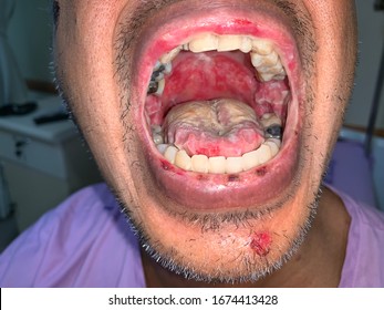 Severe Mucosal Ulcer, Patient With Sore Throat, Generalize Ulcer At Soft Palate, Lip And Buccal Mucosa, Pemphigus Valgaris