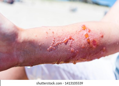 Severe And Painful Poison Ivy Rash And Infection With Blisters And Oozing 