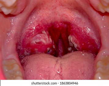 Severe Streptococcal Pharyngitis Shown In A White Adult Male.