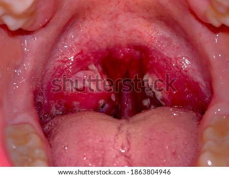 Severe Streptococcal Pharyngitis shown in a white adult male.