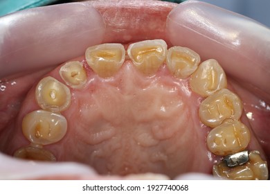 Severe teeth attrition with loss of vertical dimension