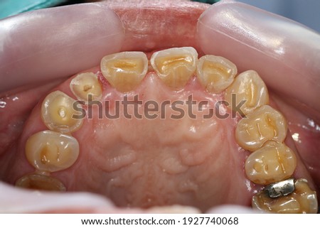 Severe teeth attrition with loss of vertical dimension