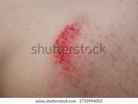 Severe wound on back scratch. Child injury and bruises concept