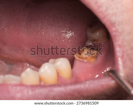Severely decayed mandibular second molar destroyed nearly to gum level, located between a long-missing first molar and a badly deteriorated third molar