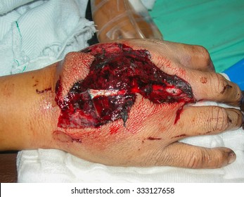 Severely Wounded  Hand  In  Emergency Room