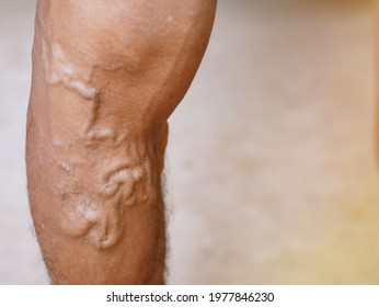 The severity of the varicose veins ranges from the tiny capillaries, pain in the legs, swollen feet and legs, and the crooked aneurysm resembles a worm.
