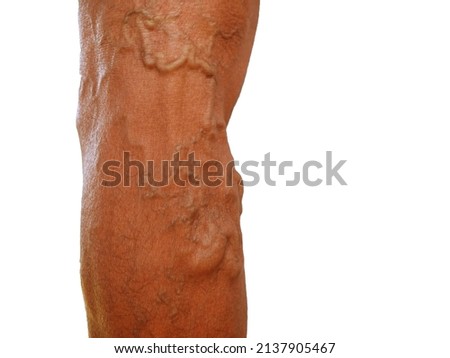 The severity of the varicose veins ranges from the tiny capillaries, pain in the legs, swollen feet and legs, and the crooked aneurysm resembles a worm.
