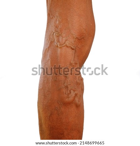 The severity of the varicose veins ranges from the tiny capillaries, pain in the legs, swollen feet and legs, and the crooked aneurysm resembles a worm.