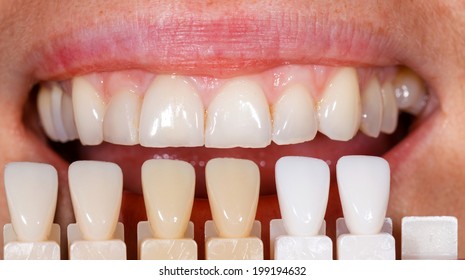 Dental Crown Color Chart