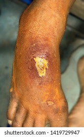 Shallow ulcer with secondary bacterial infection at dorsum of right foot in Asian Myanmar adult male patient. It is worsened by Myanmar traditional home remedy such as mixed lime and tumeric powder.