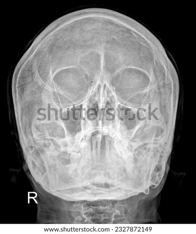 Sharp X-ray image of the sphenoid sinuses, showcasing the sphenoid bone and sinuses, useful for diagnosing sphenoid sinusitis or sinus-related headaches. Stock photo © 