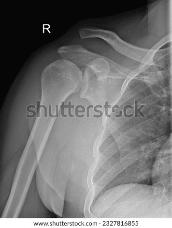 Sharp X-ray image of the upper extremities, showcasing the shoulder, humerus, ulna.