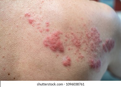 Shingles (Disease), Herpes zoster, varicella-zoster virus. skin rash and blisters on body
