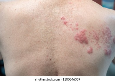 Shingles (Disease), Herpes zoster, varicella-zoster virus. skin rash and blisters on body