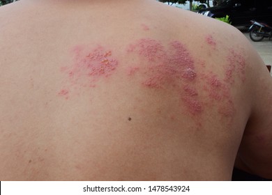 Shingles found in infected patients