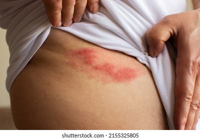 Shingles (herpes zoster) blister skin rash. - Shutterstock ID 2155325805