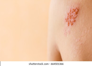 Shingles on men herpes zoster. - Shutterstock ID 664501366