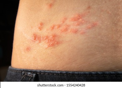 Shingles outbreak on torso. The varicella-zoster virus has formed a red rash with fluid-filled blisters on the lower back (shingles belt)