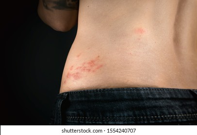 Shingles outbreak on torso of woman. The varicella-zoster virus has formed a red rash with fluid-filled blisters on the lower back (shingles belt)