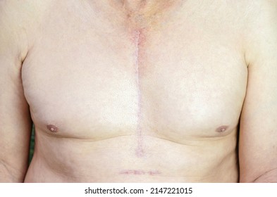 Shirtless Caucasian man with scar mark from CABG (Coronary Artery Bypass Graft) on his chest. Open heart surgery. Healthy scar.