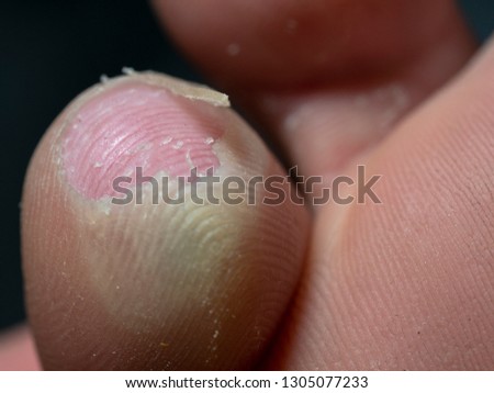 Shoe bite wounds feet finger  close up