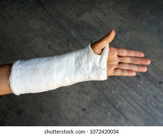 Short Arm Cast,Blurry Of Arm Splint,Injured Female Hand With Upper Part Of Body