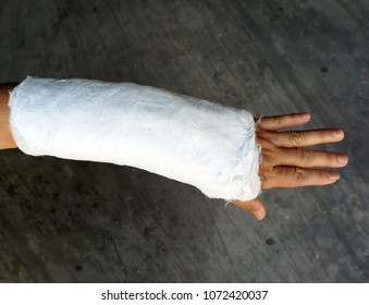 Short Arm Cast,Blurry Of Arm Splint,Injured Female Hand With Upper Part Of Body