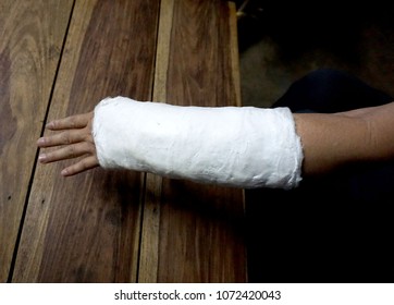 Short Arm Cast,Blurry Of Arm Splint,Injured Female Hand With Upper Part Of Body