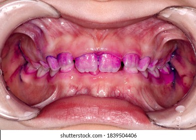 41 Lip retraction Images, Stock Photos & Vectors | Shutterstock