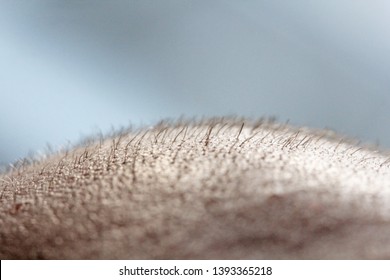 Short Hair On A Head Close Up. Scalp Man's Head. Baldness. Bald Man. Problems With Hair Growth On The Head.