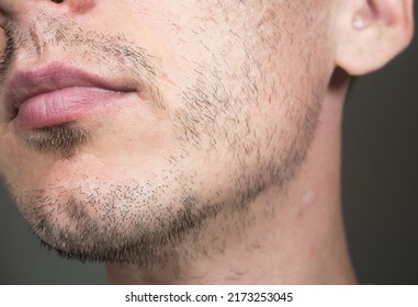 Short, sparse beard on mans face. Hair growth problems. Man with alopecia area in the beard. Unshaven bristles on the beard.