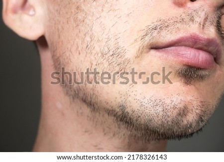 Short, sparse beard on mans face. Hair growth problems. Man with alopecia area in the beard. Unshaven bristles on the beard.