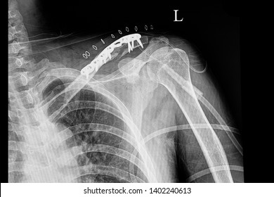 A Shouder Film Xray Of A Traumatic Patient With Fractured Left Clavicle After Plate And Screw Fixation. 