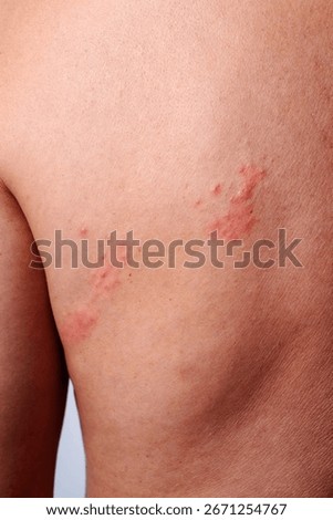 the shoulder blade and upper back of a man display red lesions and blisters clustered together, characteristic of a shingles flare up causing pain and skin irritation