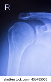 Shoulder Joint Injury Xray Traumatology Orthopedics Stock Photo ...