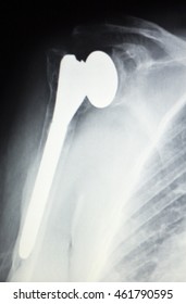 Shoulder Joint Replacement Orthopedic Titanium Metal Traaumatology Ball And Socket Implant X-ray Image Of Old Age Patient.