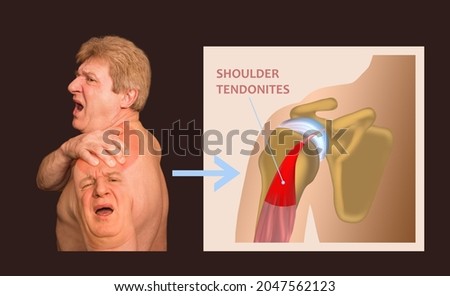 Shoulder joint structure and shoulder tendonitis. The collage of senior man with shoulder pain over black background. Healthcare concept