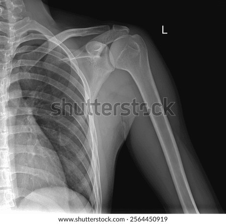 Shoulder Joint X-ray in AP View