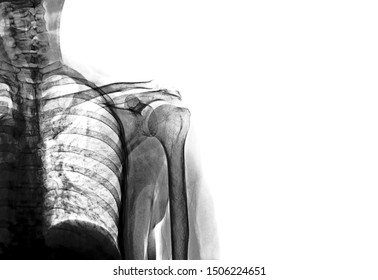 Shoulder x ray anatomy radiology. Radiographic Anatomy - Hand AP Medical Coding, Anatomy And Physiology  color on black background - Powered by Shutterstock