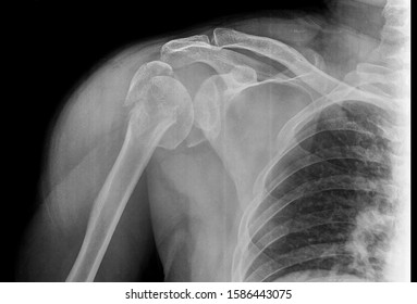 Shoulder x-ray showing closed comminution fracture of the proximal humerus with greater tuberosity displacement. The collar bone is normal. The patient need open reduction and internal fixation.