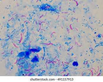 Show Micro-bacterium Tuberculosis. (TB) ,Positive Acid Fast Bacilli. (AFB 3+) Specimen For Sputum.