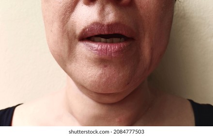 Showing The Sagging Corner Of The Mouth, Wrinkle Problem Skin On The Face, Layered Under The Neck.