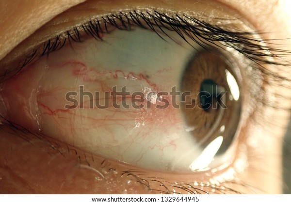 Sick eye
background / Red eyes is a condition where the white of the eye the
sclera has become reddened or
bloodshot.