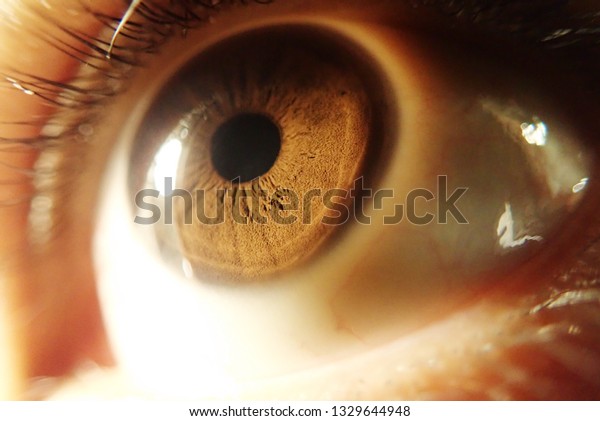 Sick eye\
background / Red eyes is a condition where the white of the eye the\
sclera has become reddened or\
bloodshot.