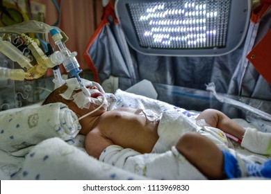 Sick Newborn Baby On Breathing Machine (mechanical Ventilator) With Orogastric Tube In Neonatal Intensive Care Unit.