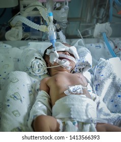 Sick newborn baby on breathing machine (mechanical ventilator) with orogastric tube in neonatal intensive care unit.