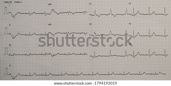 Sick Sinus Syndrome Rbbb Post Pacemaker Stock Photo 1794192019 ...