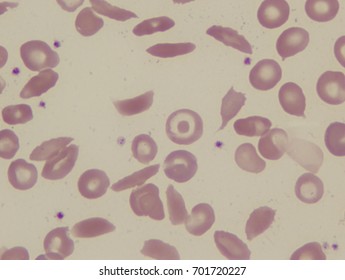 Sickle Cell