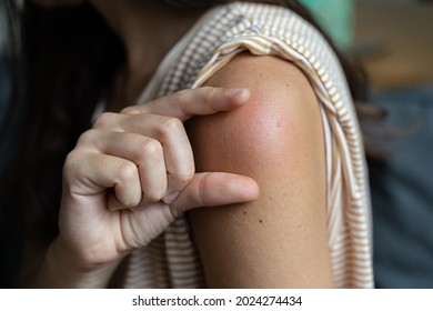 Side Effect Of The Vaccine - Shoulder Skin Redness And Pain. Covid-19 Vaccination Reaction. Woman Skin Itchy And Swelling After Vaccine Shot